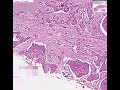 Histopathology Esophagus, liver--Squamous cell carcinoma wit