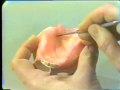 Custom Acrylic Resin Impression Tray Fabrication