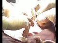 CESAREA BEBE PELVICO CESAREA BEBE PELVICO