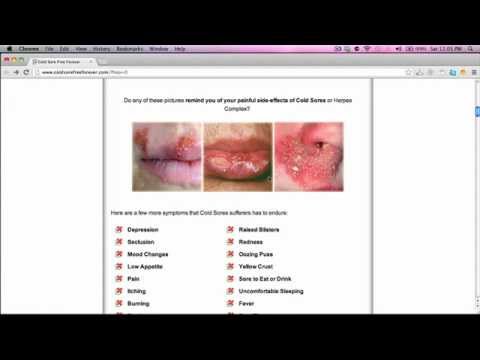 how to cure cold sores
