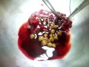 Gall bladder-stones Gall bladder-stones