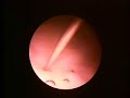 Botox bladder injection