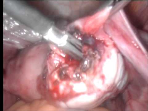 how to cure ectopic pregnancy