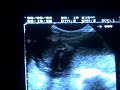 Ultrasound or Sonogram Pregnancy 31 weeks... Its a boy ! - Ultrasonido 31 semanas ... Es un niño!
