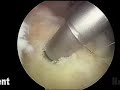Dr. Spero Karas - Double Row Rotator Cuff Repair