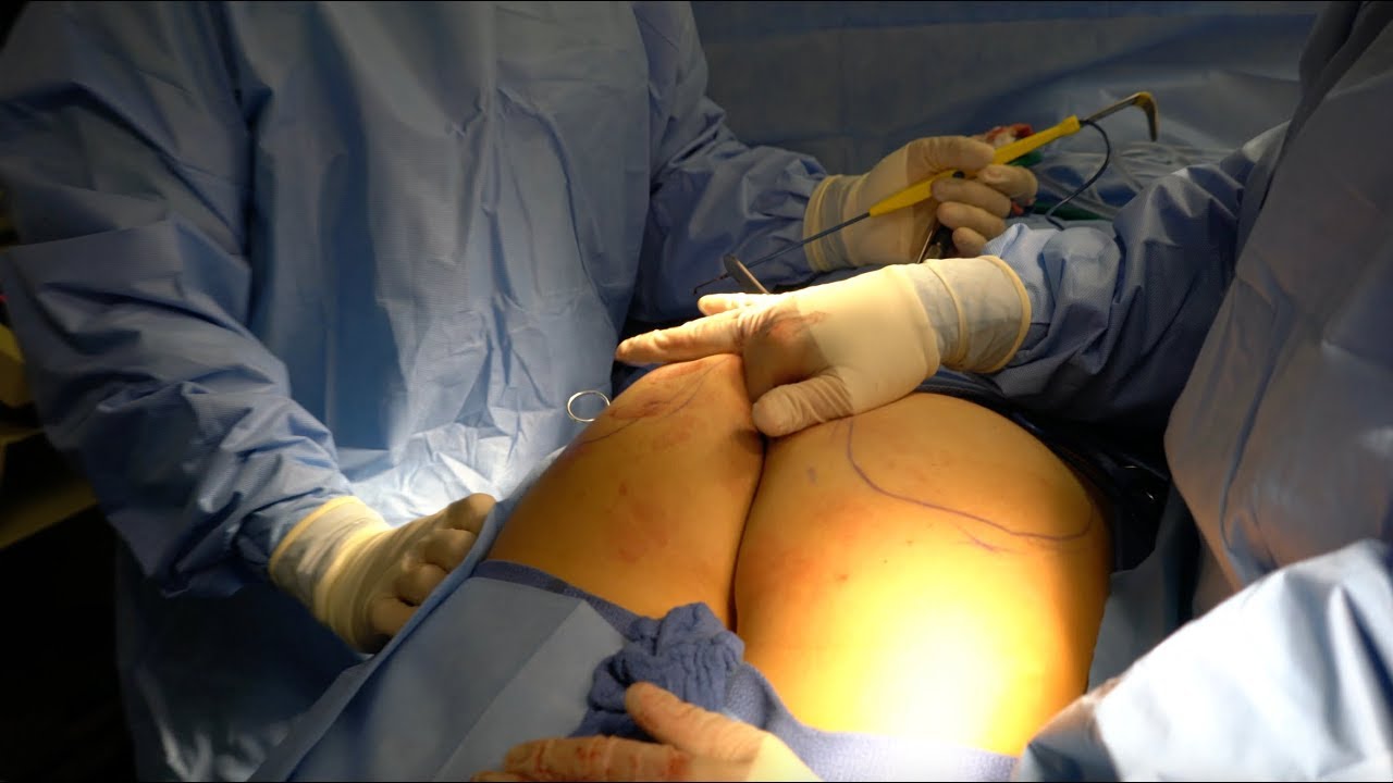 BUTT IMPLANTS IN 4K (Buttock enhancement surgery)