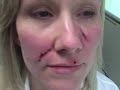 DALLAS MOLE REMOVAL DIARY