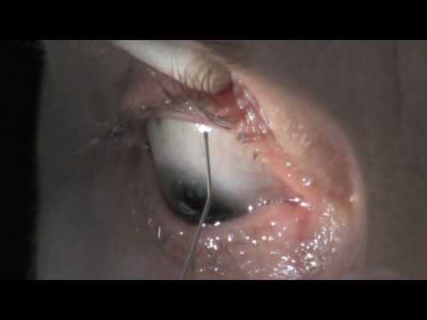how to unclog meibomian gland