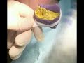 Cosmetic Dentistry one minute with Dr.Jean-Jacques Edderai