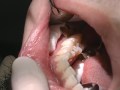 歯周病細菌検査　サンプリング法