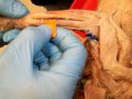 Flexor side: 1) pronator teres: small...