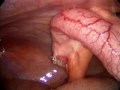 Appendectomy ������� ������� ������� 