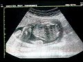 5 meses