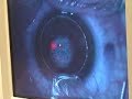 traitement laser excimer traitement laser excimer