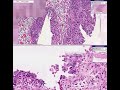 Click here to watch this video Histopathology Bladder Transitional Carcinoma-in-situ
