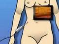 PreOp® Patient Education Laparoscopy Diagnostic Surgery