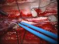 Arteriovenous Malformation Of The Spinal Cord