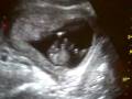 videos de Baby Girl Hughes 12/3/08 Sonogram #2 - Boy or Girl?