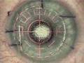 LASIK