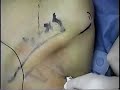 Bloqueo interescalenico