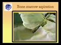Pediatric Bone Marrow Aspiration