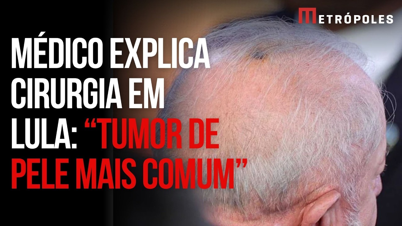 Médico de Lula explica cirurgia para a retirada de tumor em couro cabeludo