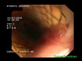 Stent In Esophagus - Replacement
