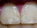 WATER FLUORIDE CARRIES WITH IT MANY GREAT HEALTH RISKS. IT DOES NOT WORK WELL, AND NOW THAT WE HAVE FLUORIDE TOOTHPASTE, WE NO LONGER NEED THE EXPENSE OF PAYING FOR FLUORIDE WATER TO WASH THE CAR AND WATER THE GRASS. TIME TO END THIS ANCIENT HARMFUL PRACTICE
