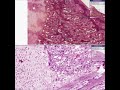 Histopathology Bone --Rickets