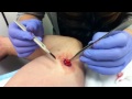 Surgical removal of a lipoma or cyst