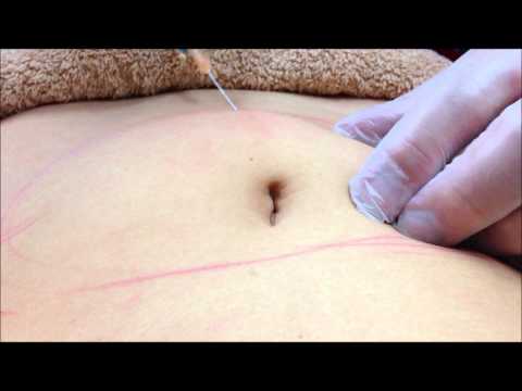 how to dissolve face fat