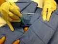 Cyst Removal