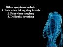 Costochondritis as a cause of chest pain