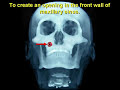 How To Get Rid Of Fungus In Your Sinus
