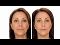 Juvaderm Restylane Radiesse Facial Fillers Sarasota FL Juvaderm Restylane Radiesse Facial Fillers Sarasota FL