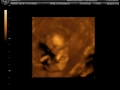 Ultrasound Vid at 14 weeks 2 days