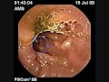 CAPSULE ENDOSCOPY