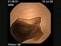 CAPSULE ENDOSCOPY