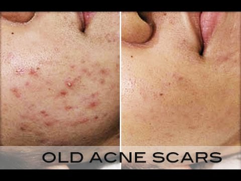 how to get rid of acne by a week