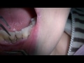 歯槽膿漏