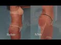 Brazilian Butt Lift Brazilian Butt Lift