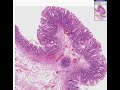 Histopathology Colon--Hyperplastic polyp