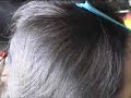 ExtendMagic Demo - Hair Loss Treatment