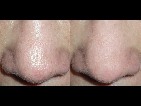 how to get rid nose pores