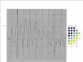 Atrial  torsades de pointes