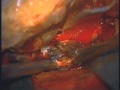 Access To The Cranium Middle Fossa - Part 3 Access To The Cranium Middle Fossa - Part 3