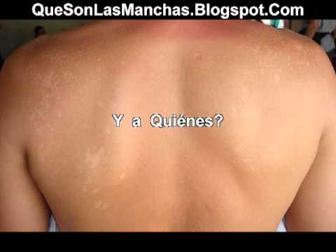manchas en la piel - http://youtu.be/P7TnXwdsNIk ▻ http://quesonlasmanchas.blogspot.com Manchas Blancas En La Piel - A Qué Se Deben Las Mancas Blancas En La Piel? Para poder hace...