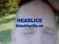 Does Nalts Have Head Lice?