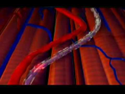 اعتلال الأعصاب السكري