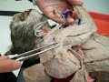 Shoulder Muscles: 1) Clavicular...